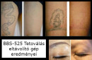 Beauty Body System Tetoválás eltávolító gép | BBS-525